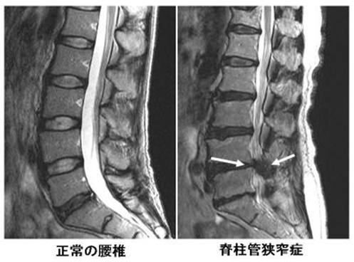 脊柱管狭窄症は脊柱管という神経の通り道が圧迫される