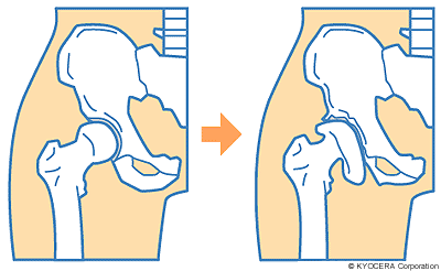 変形性股関節症の図